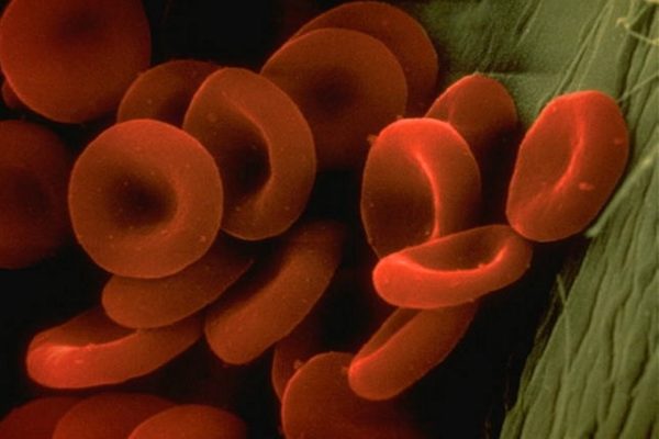 La hipertensión arterial