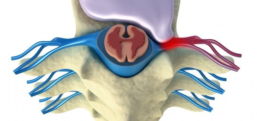Hernia discal y quiropráctica