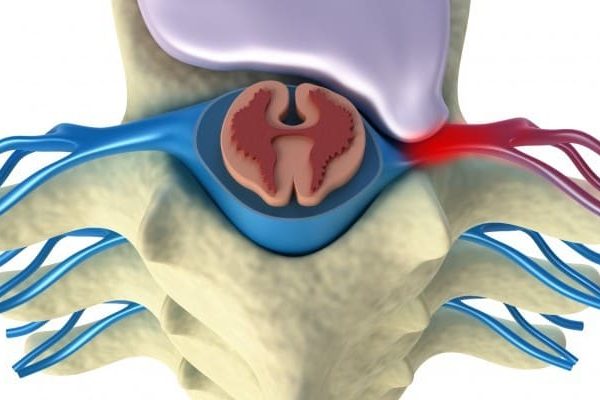 Hernia discal y quiropráctica
