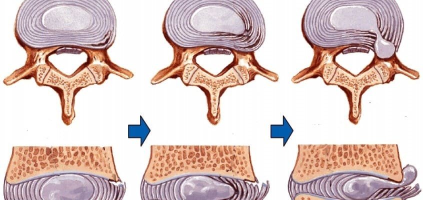 espondilitis y quiropráctica