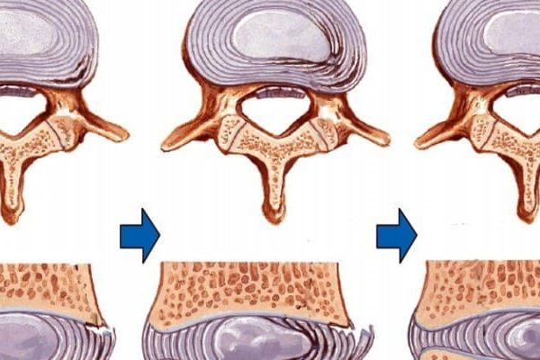 espondilitis y quiropráctica