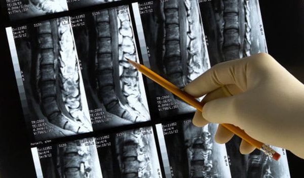 Dolor lumbar Mataró