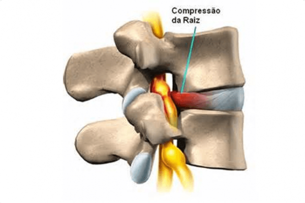 Hernia discal Masnou