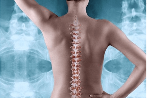 Artrosis proceso de degeneración espinal