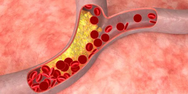 Colesterol clinica Mayo