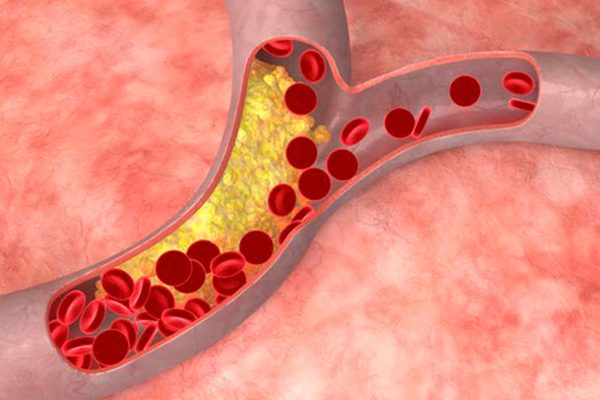 Colesterol clinica Mayo