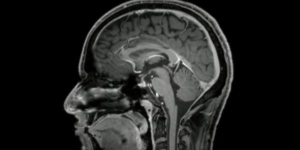 Las Hernias Discales Afectan Al Cerebro