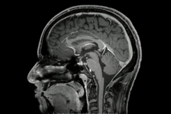 Las hernias discales afectan al Cerebro