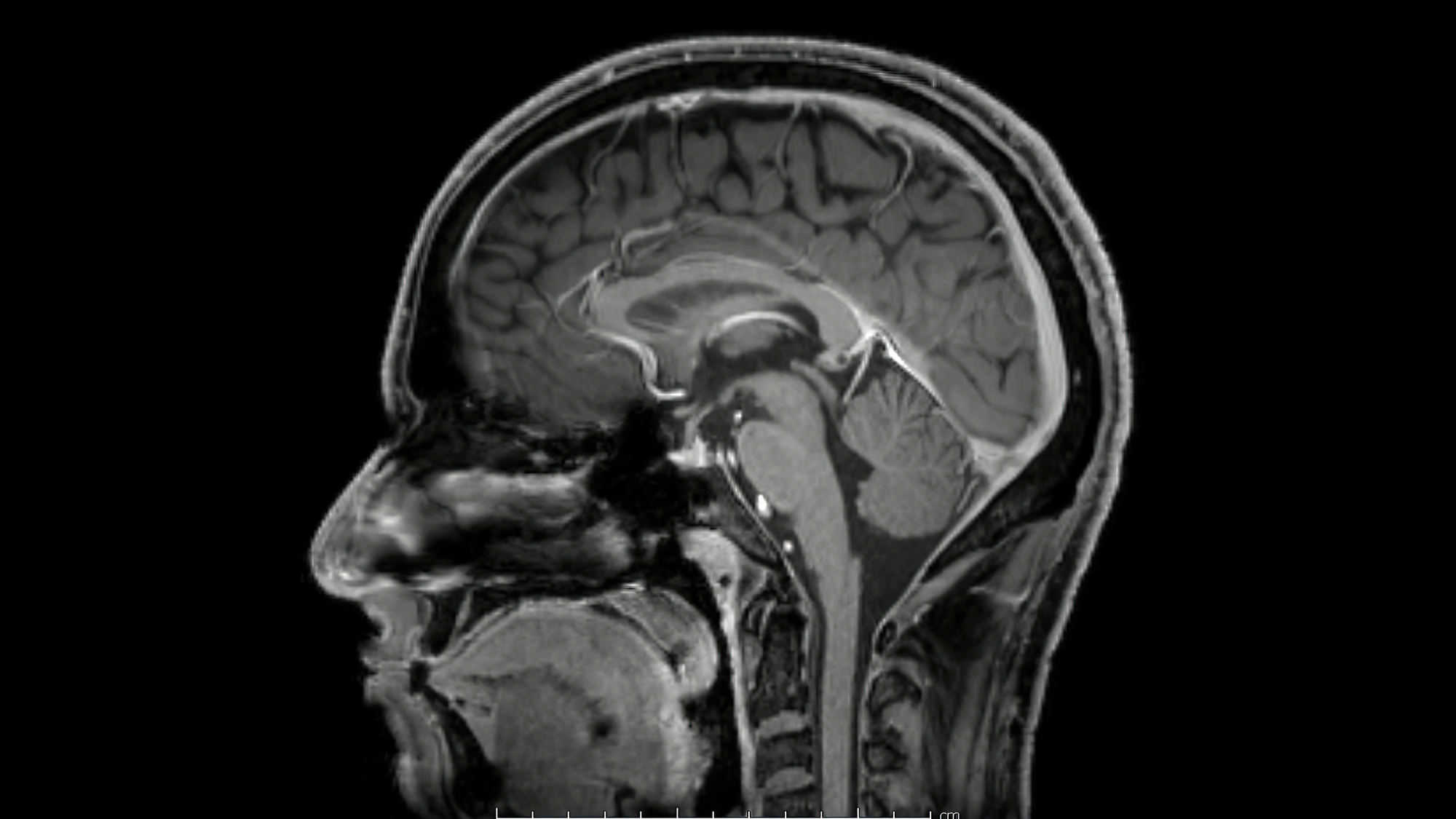 Las hernias discales afectan al Cerebro