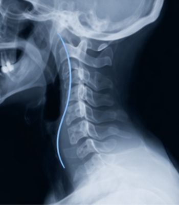 Curvatura normal de la columna cervical