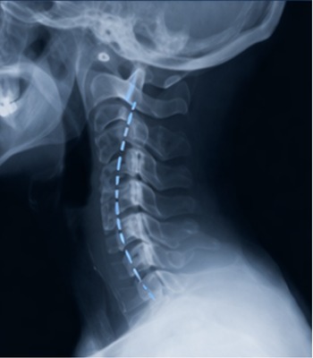 Fase 1 de degeneración - Inicio